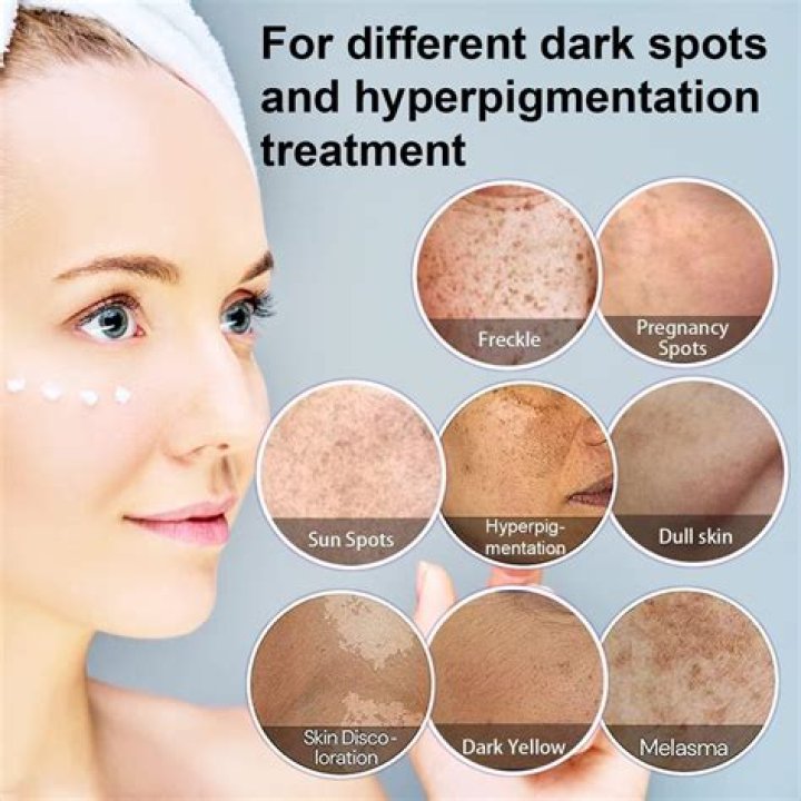 Does potato remove pigmentation?