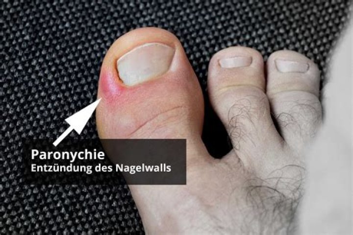 Was ist eine Nagelwurzel?